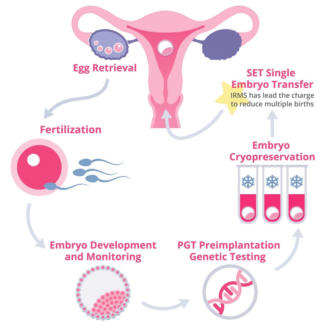 IVF